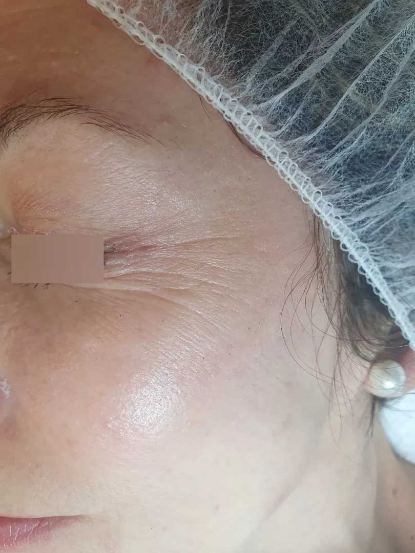 Pred proceduro s pilingom HL Anti Age