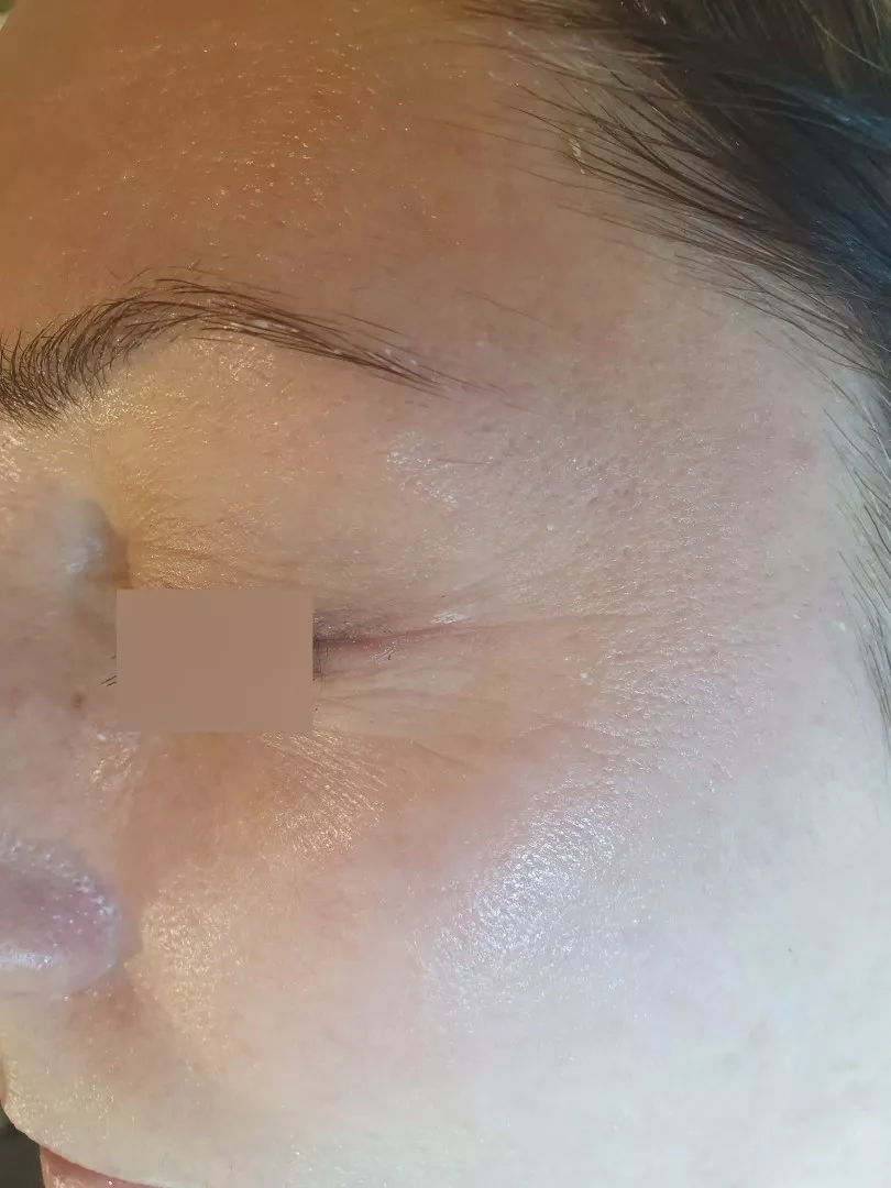 Po proceduri s pilingom HL Anti Age