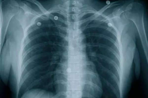 Rentgensko slikanje skeleta in pljuč