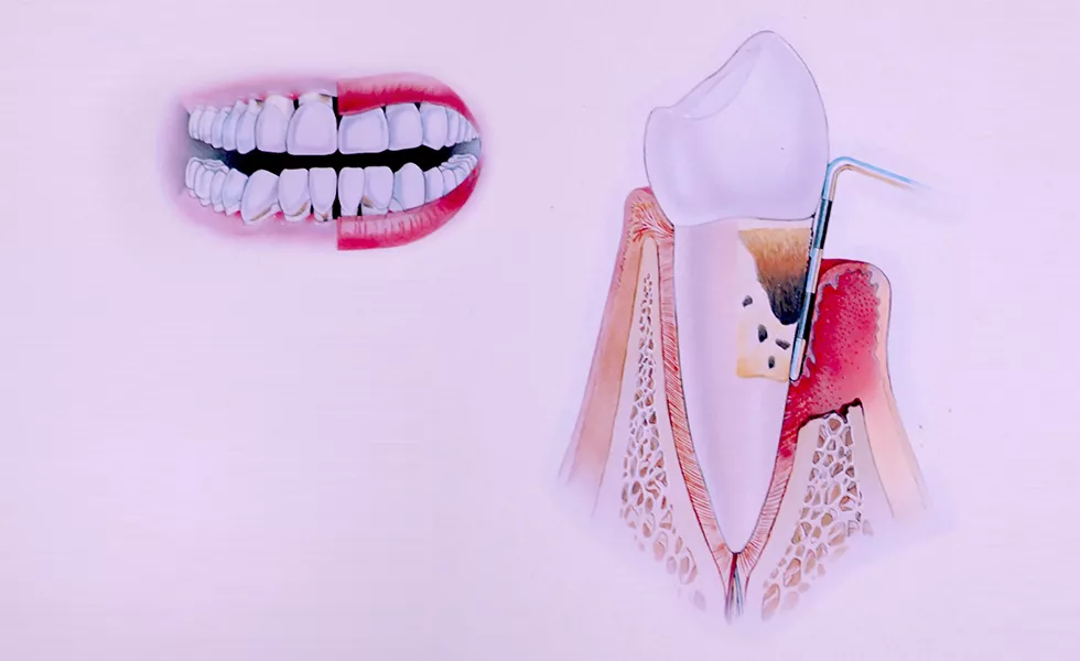 Zdravljeje dlesni - parodontologija